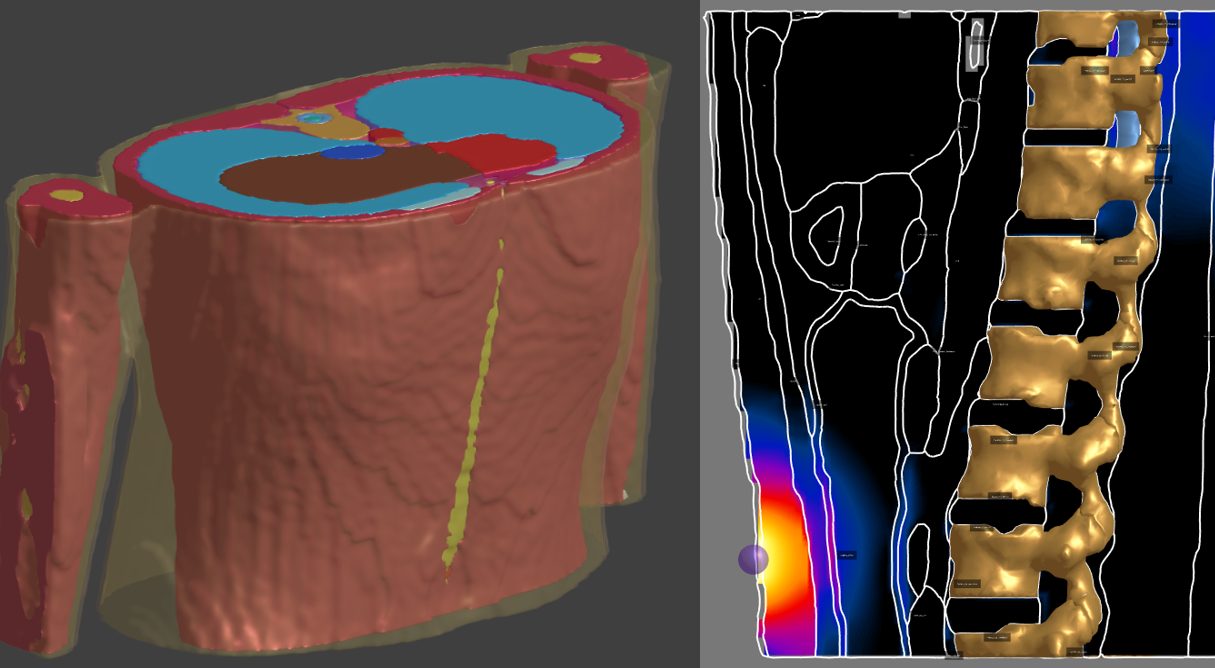 个人化脊椎电刺激模拟