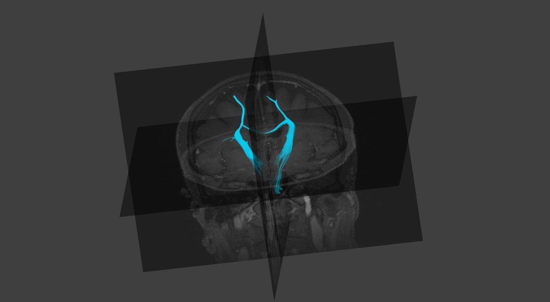 MRI 與神經束模型對齊